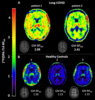 Escáner PET de 2 personas con covid persistente y un grupo de control formado por 3 personas sanas. Los colores verde, amarillo, naranja y rojo señalan la inflamación. Los colores azul y negro señalan el tejido cerebral sano. De: Visser D, Golla SSV, Verfaillie SCJ, Coomans EM, Rikken RM, van de Giessen EM, et al. Long COVID is associated with extensive in-vivo neuroinflammation on [ 18 F]DPA-714